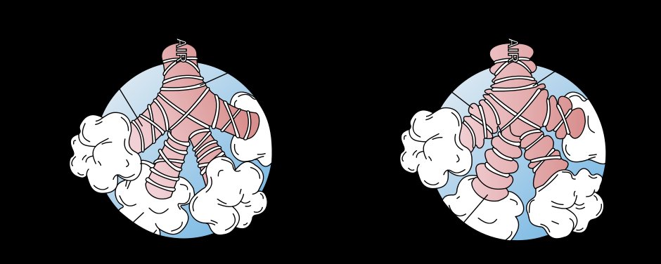 Bronchospasm - Source Wikipedia